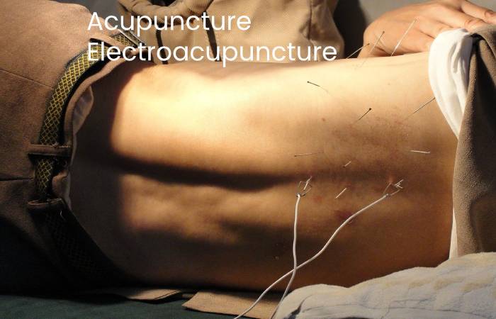 Acupuncture