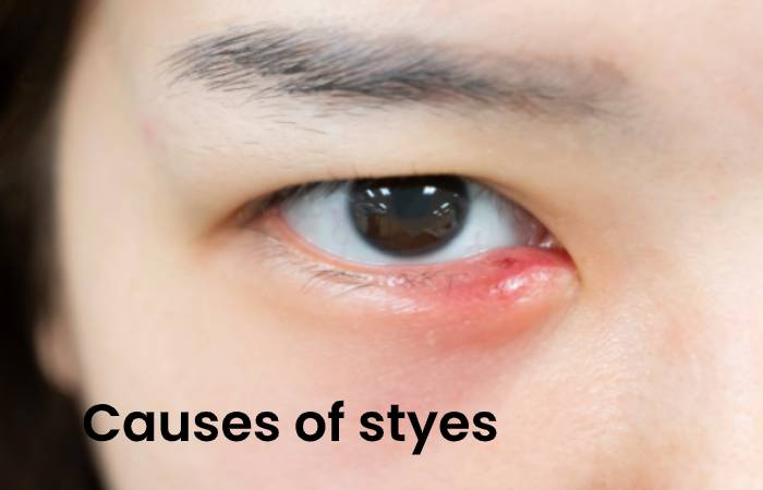 Causes of styes